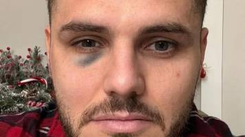 Mauro Icardi terminó con el ‘ojo morado’ tras un partido con polémica en Turquía